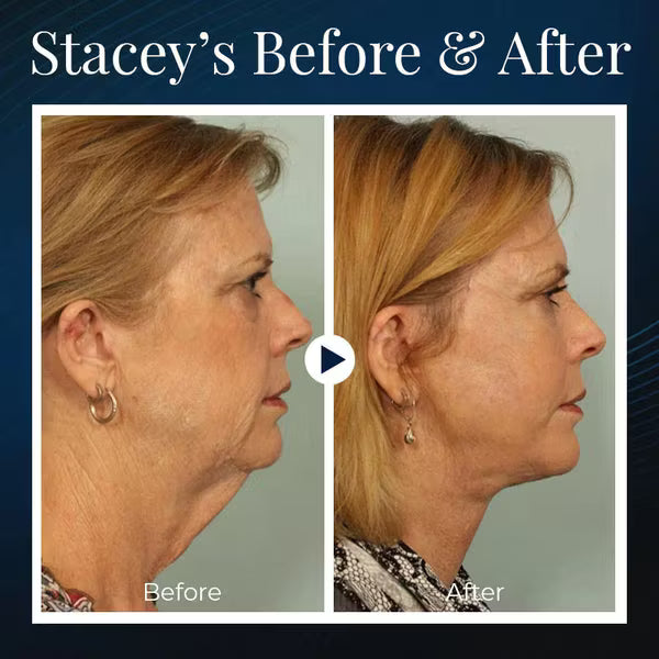 💝HOT SALE🔥-Sleeping V-Face Beauty Device