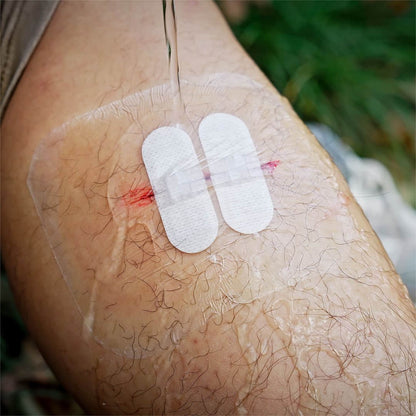 Wound Closure Device