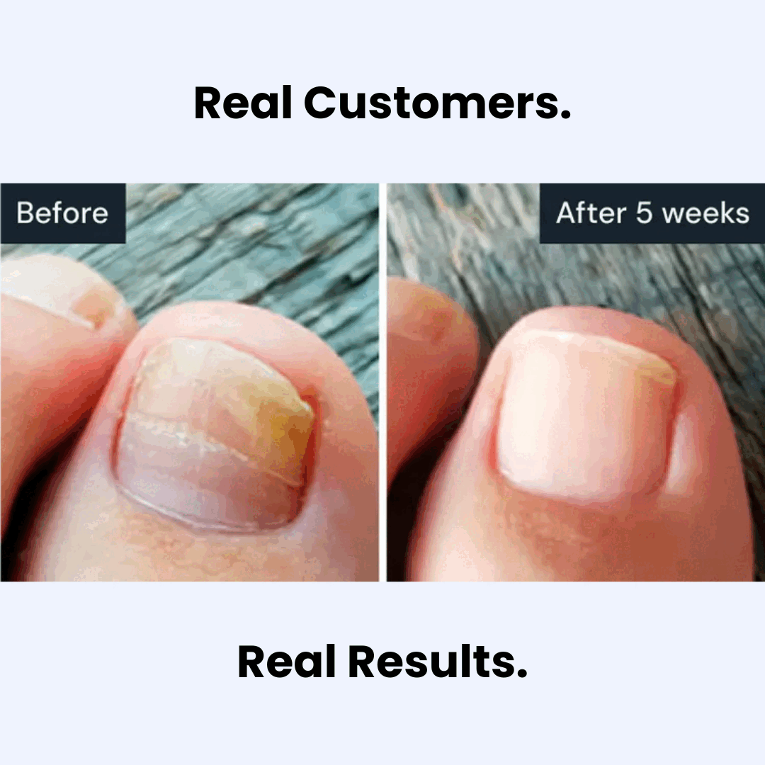 Antifungal Nail Pen | Extra Strength Toenail Fungus Treatment & Repair Solution💯