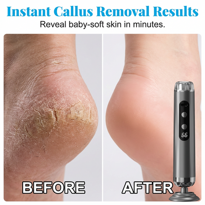 Last Day 50% OFF🔥Multi-Function Electric Foot Grinder with 5 Speeds